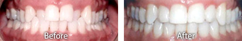 Invisalign Tempe AZ