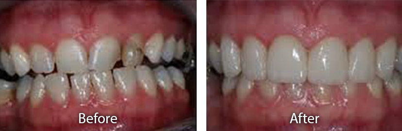 Porcelain Veneers Tempe AZ