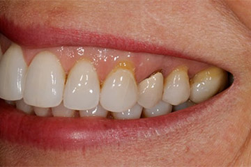 Dental Crowns Tempe AZ