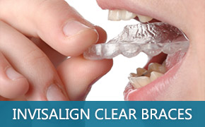 Invisalign Tempe AZ