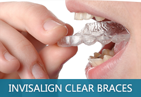 Invisalign Tempe AZ