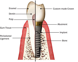Dental Implants Tempe AZ