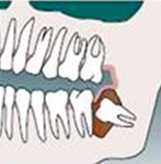 Wisdom Tooth Cyst Formation Tempe AZ